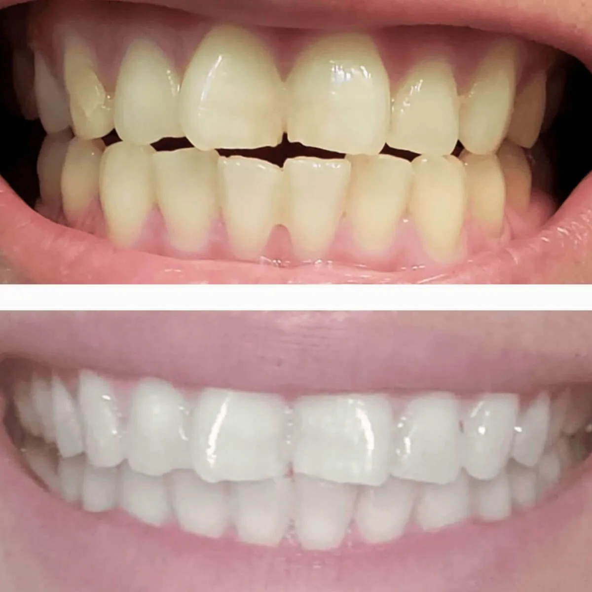 DiamondSeries® Wireless Teeth Whitening Kit with Hydroxyapatite (3 serums)